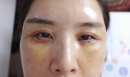 一女子子花3千割眼袋3个月眼睛闭不合